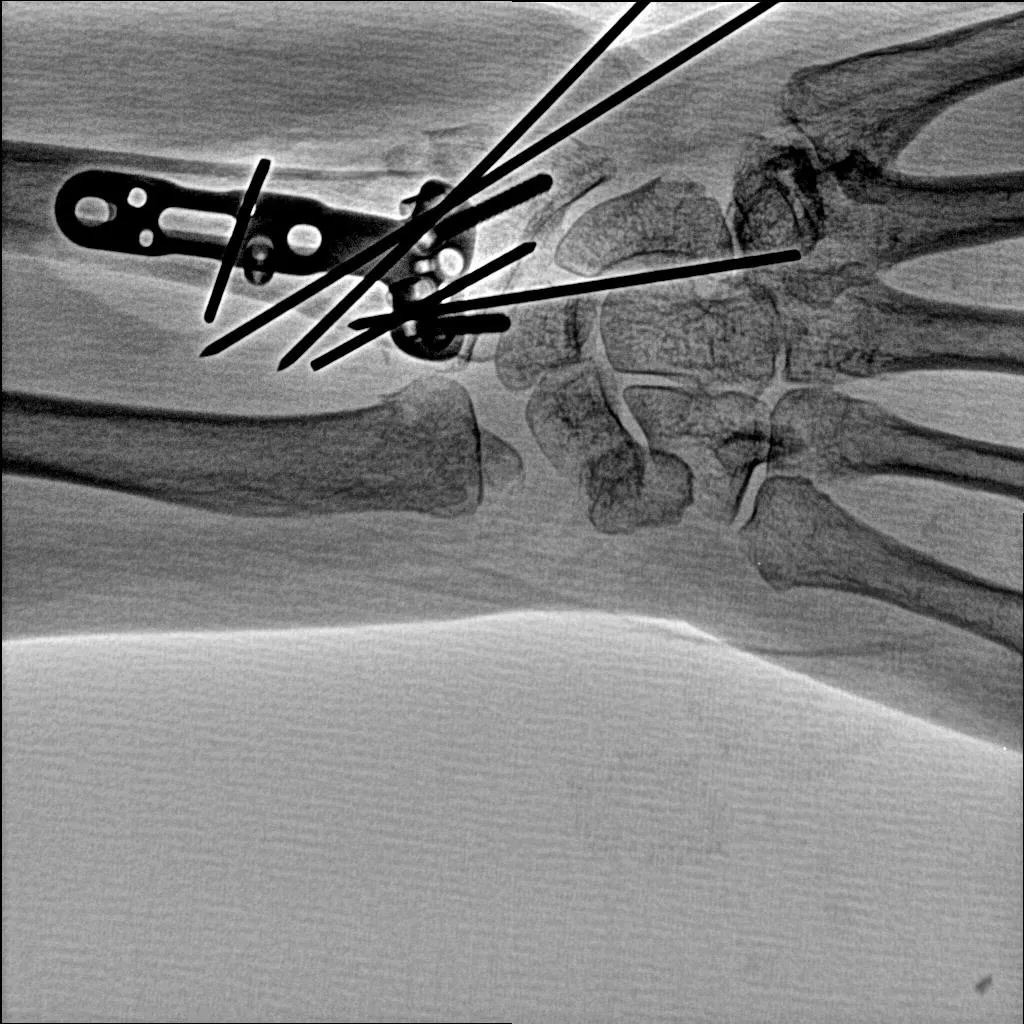 mobile c arm