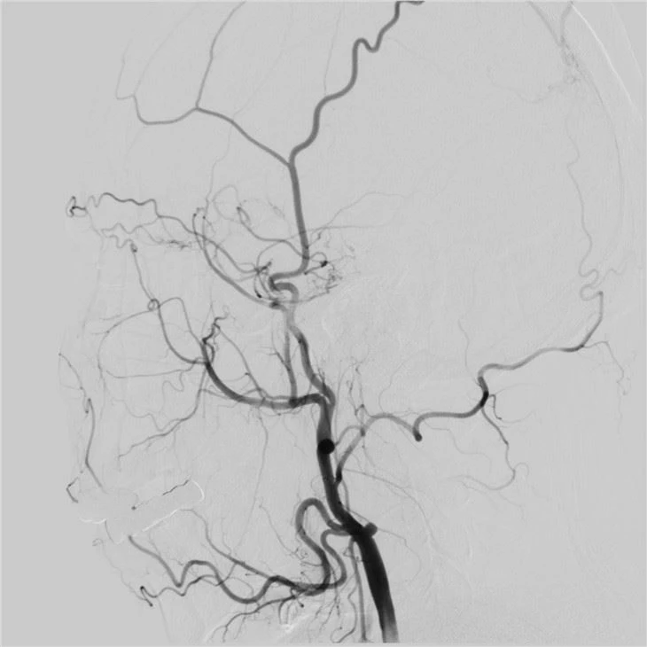 Single-plane Digital Angiography System